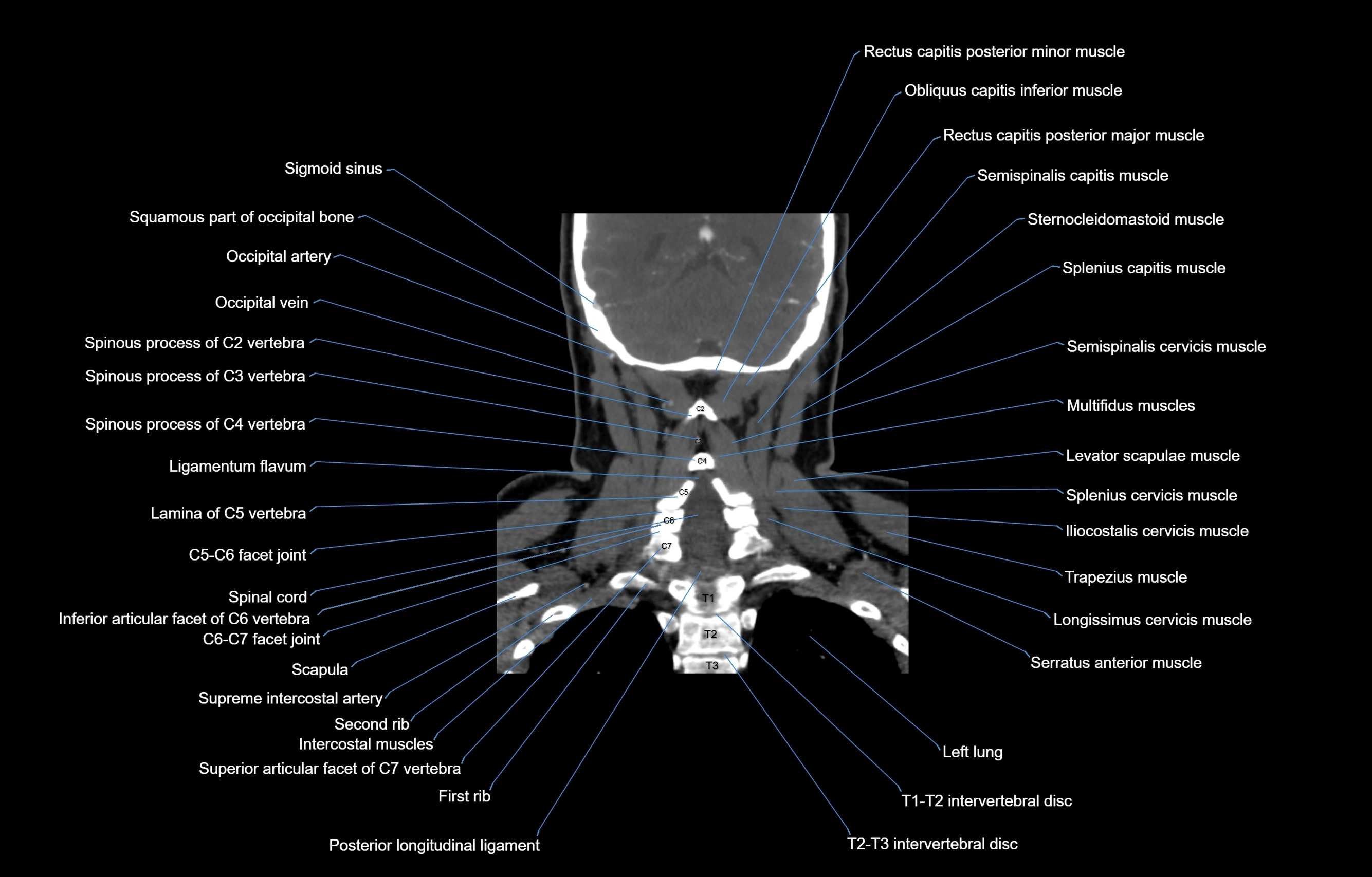 CT Neck coronal  cross sectional anatomy labelled 3D  radiology  image-00050.webp